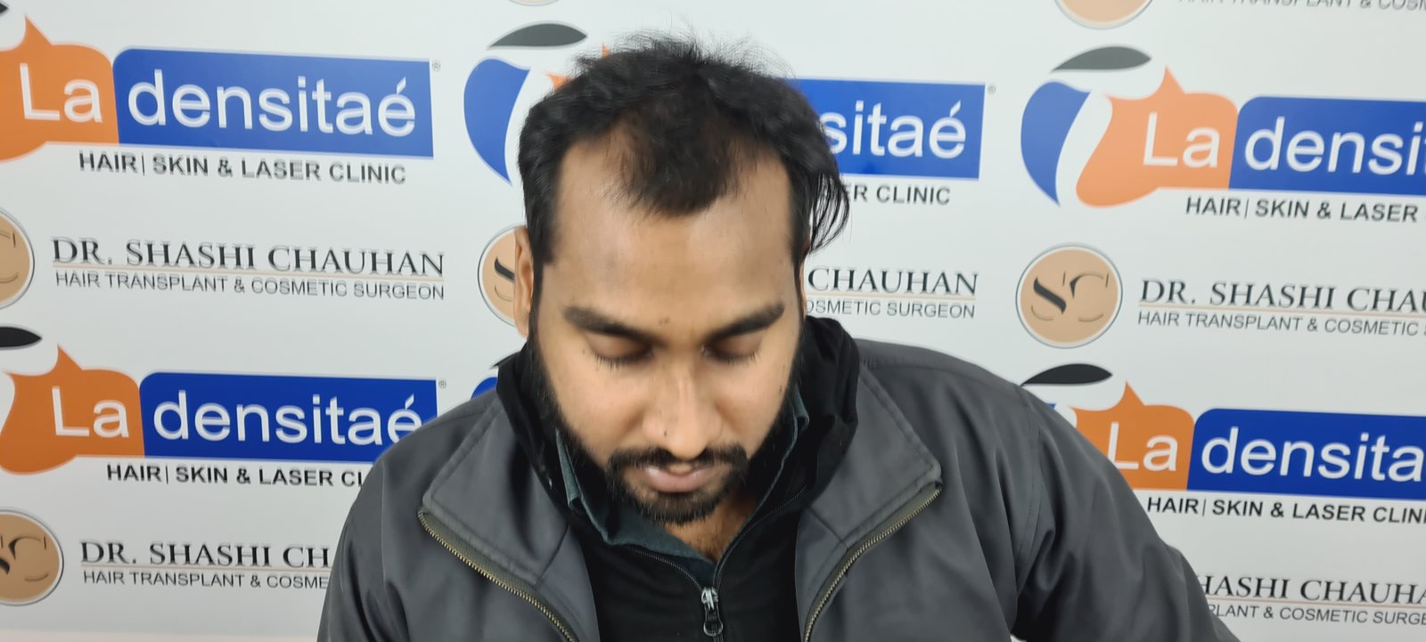 Shreyankar Maurya Before Hair Transplant